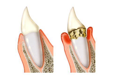 最先端の歯周病治療・再生療法