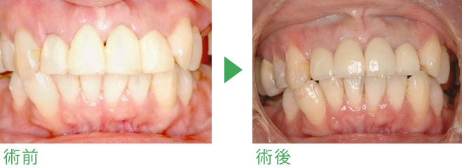 オールセラミックの症例