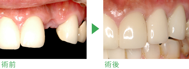 インプラント症例