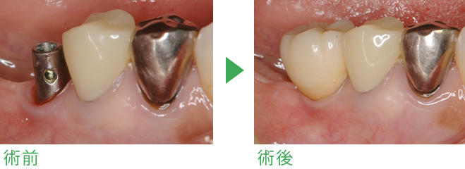 インプラント症例