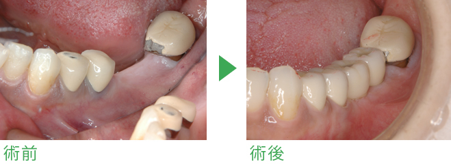 インプラント症例