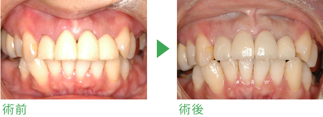 MTM（部分矯正）の症例